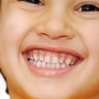 Gum Diseases